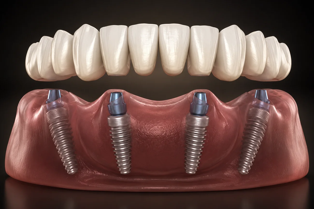 A full-arch fixed bridge supported by implants
