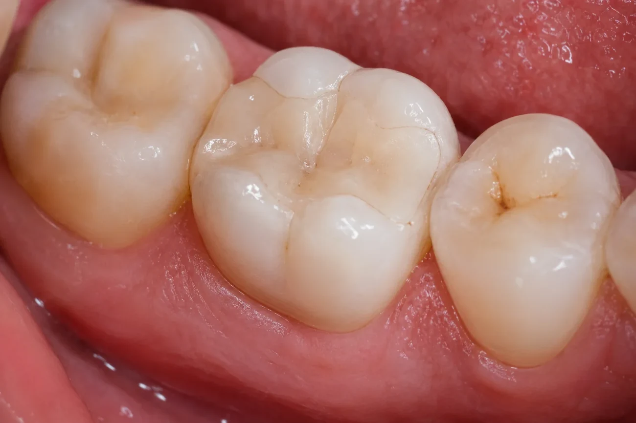 A tooth restored with a seamless tooth-colored ceramic onlay