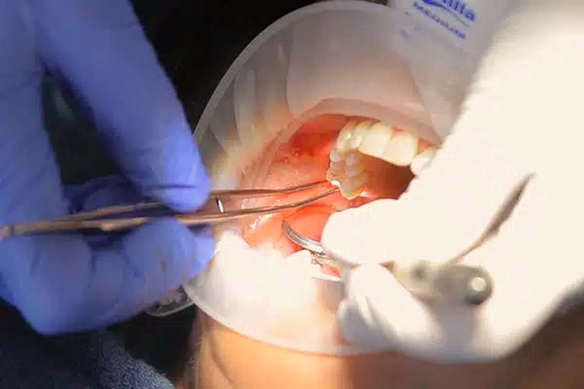Biological cavitation treatment in progress at Sunset Biological Dentistry