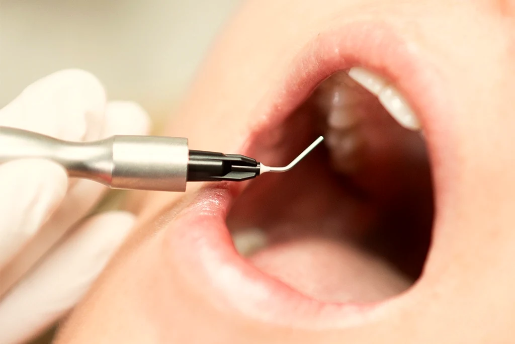 Close-up of medical-grade ozone being applied during a dental treatment