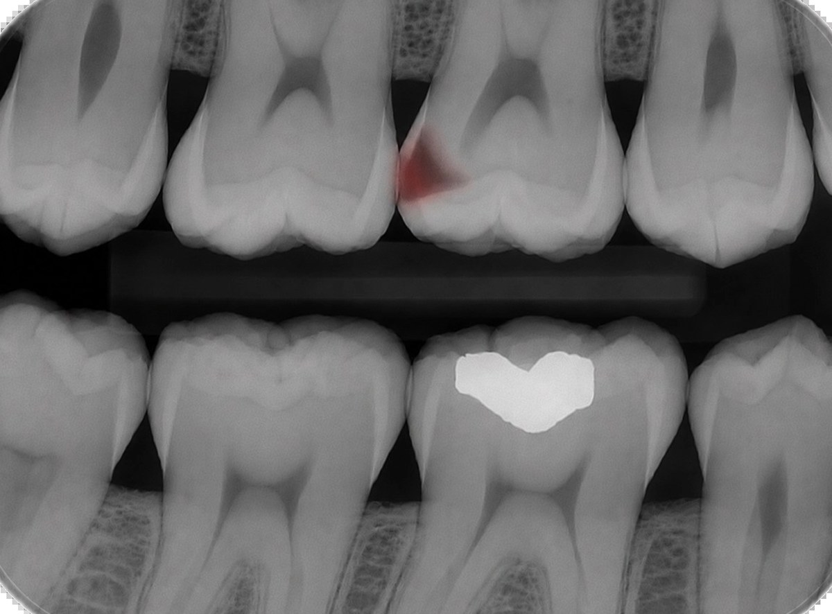 Dental X-ray showing a deep cavity nearing the tooth's nerve