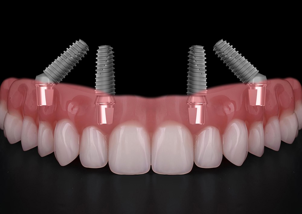 All-on-X full-arch dental implants