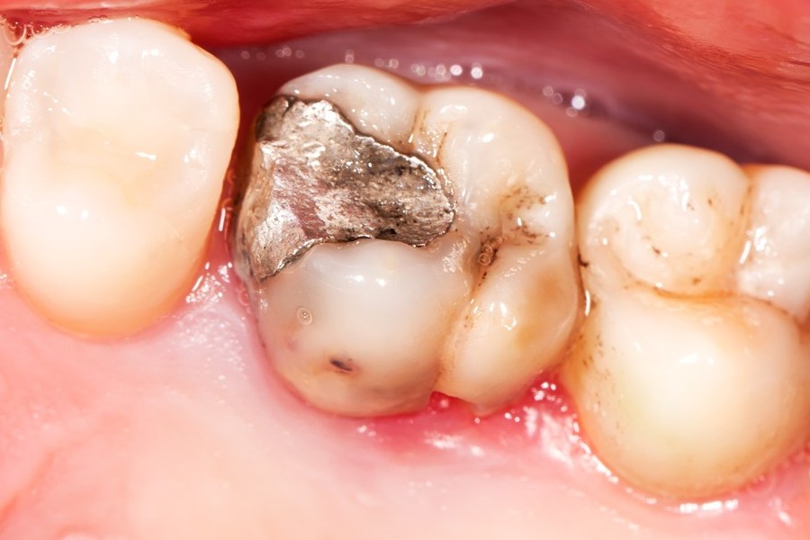 Amalgam removal