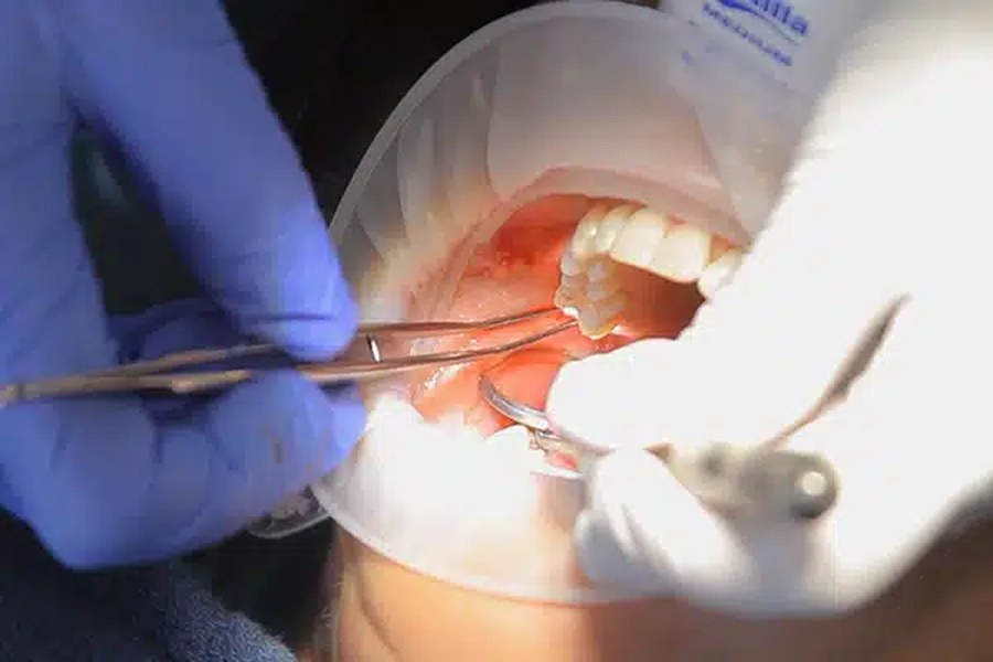 Cavitation surgery