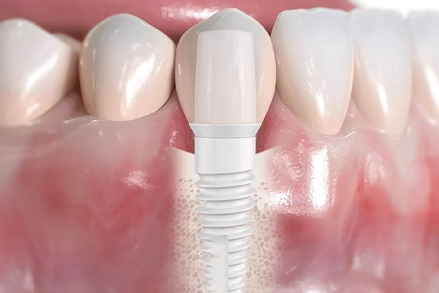 Ceramic implants