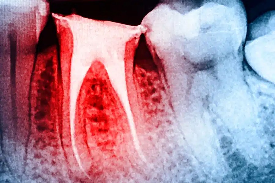 Root canal prevention